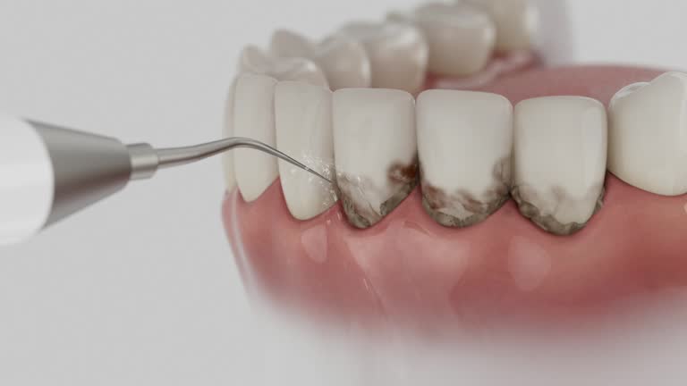 Trusted Teeth Cleaning And Checkup service in St. Bernard, OH - Dentist Open Now